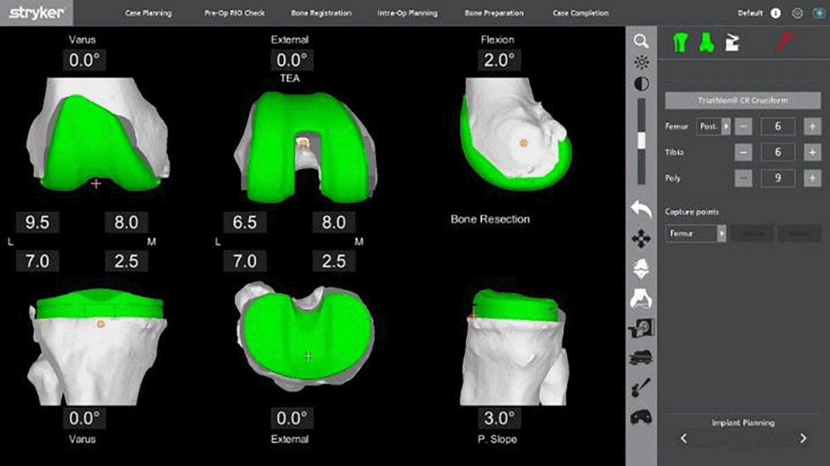 Mako Robotic Assisted Knee Replacement Specialist Knee Surgeon In