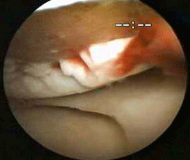 articular-cartilage-damage-photo