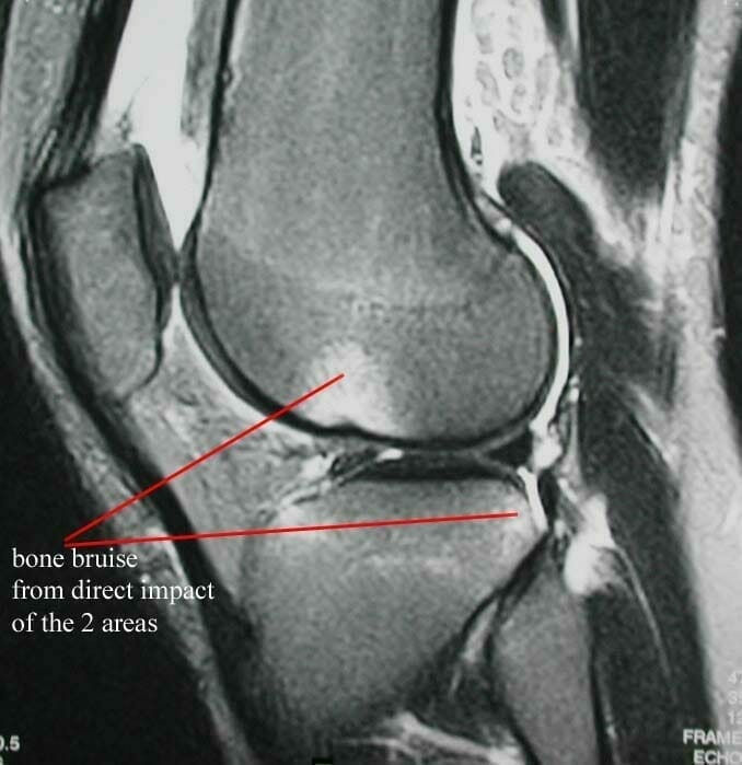 articular-cartilage-dmage-bone-bruise