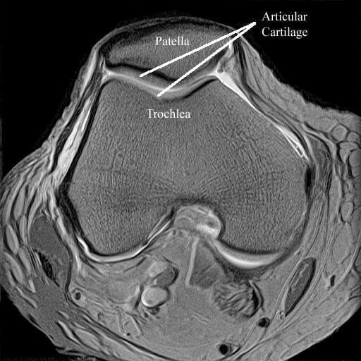 patello-femoral-problems-mri