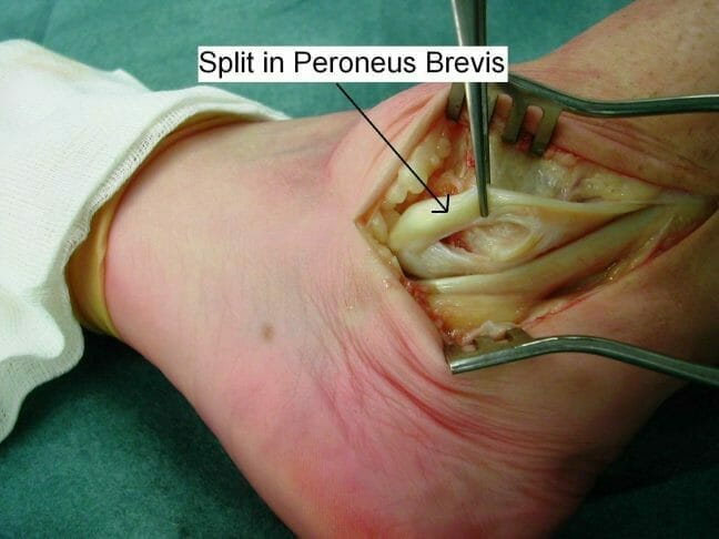 subluxing-peroneal-tendon-split