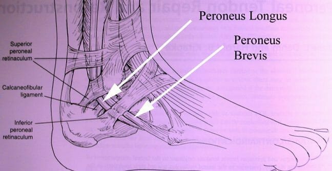 subluxing-peroneal-tendons-diagram